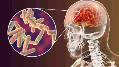 مرض إلتهاب السحايا