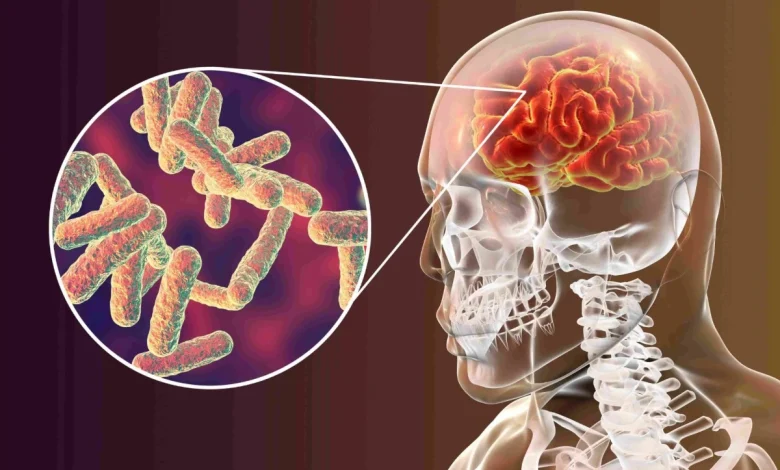 مرض إلتهاب السحايا