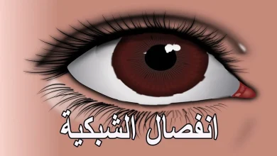 انفصال الشبكية