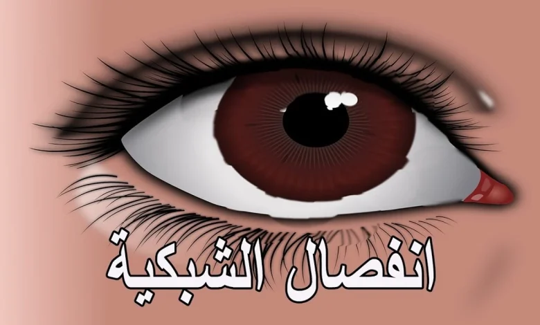 انفصال الشبكية