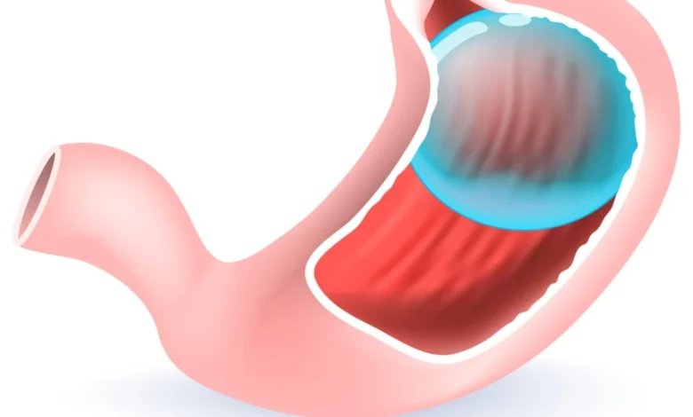 بالون المعدة