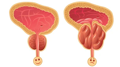 تضخم غدة البروستات
