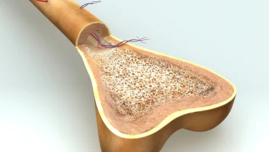 التصلب النخاعي