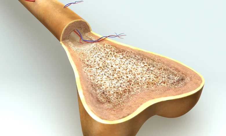 التصلب النخاعي