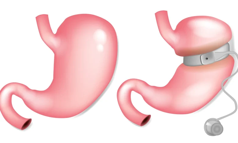 عملية ربط المعدة