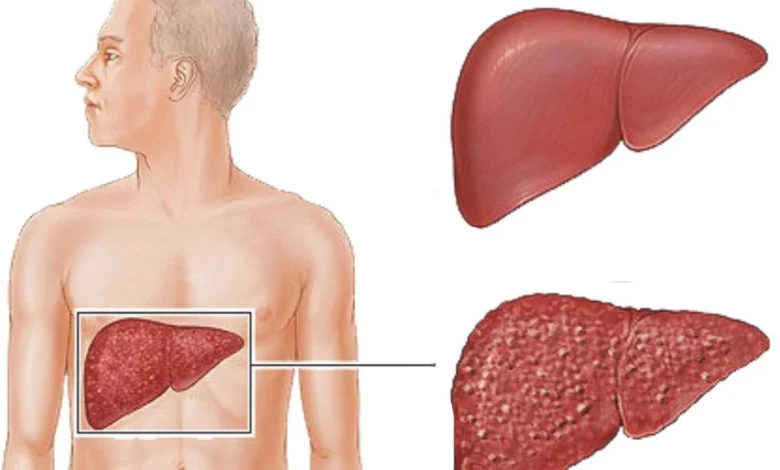 مرض غيبوبة الكبد