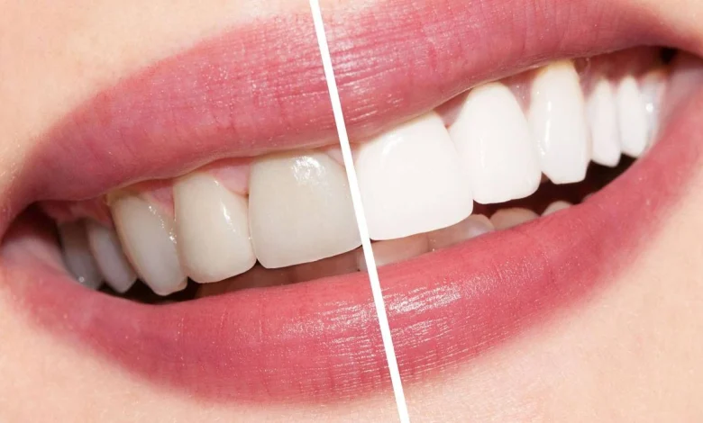 طرق تبييض الاسنان