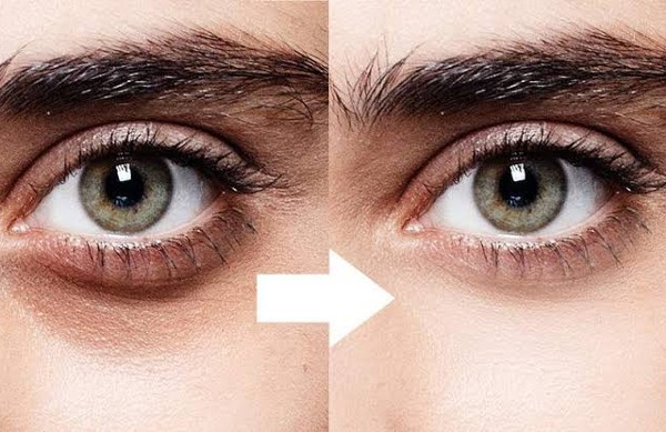 علاج الهالات السودة