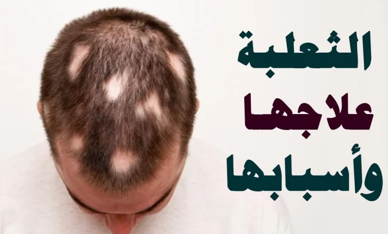 مرض الثعلبة