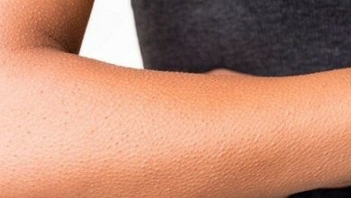 علاج جلد الوزة ونصائح لمنع ظهورها