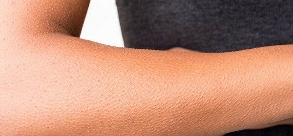 علاج جلد الوزة ونصائح لمنع ظهورها