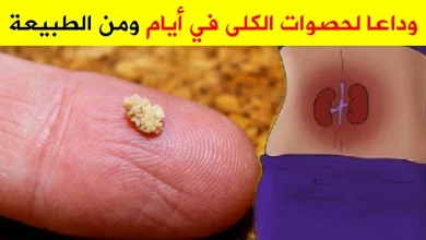 أفضل علاج لتفتيت حصى الكلى