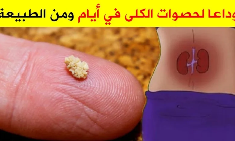 أفضل علاج لتفتيت حصى الكلى