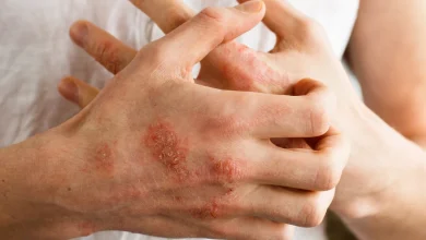 أعراض الأكزيما وعلاجها