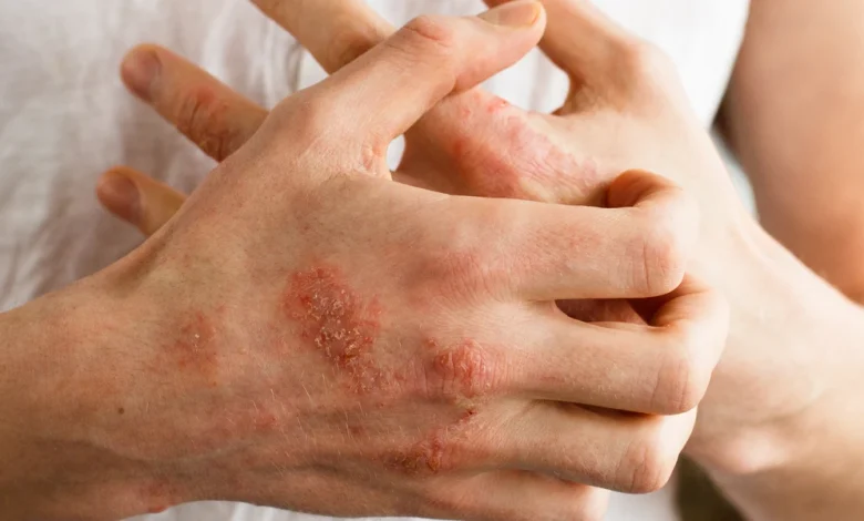 أعراض الأكزيما وعلاجها