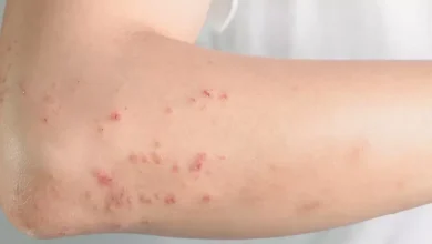 حساسية الأرتكاريا