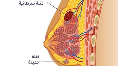 كيف يكون وجع سرطان الثدي