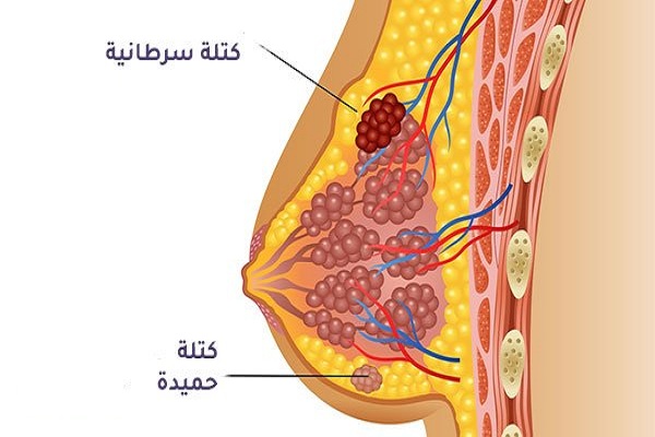 كيف يكون وجع سرطان الثدي