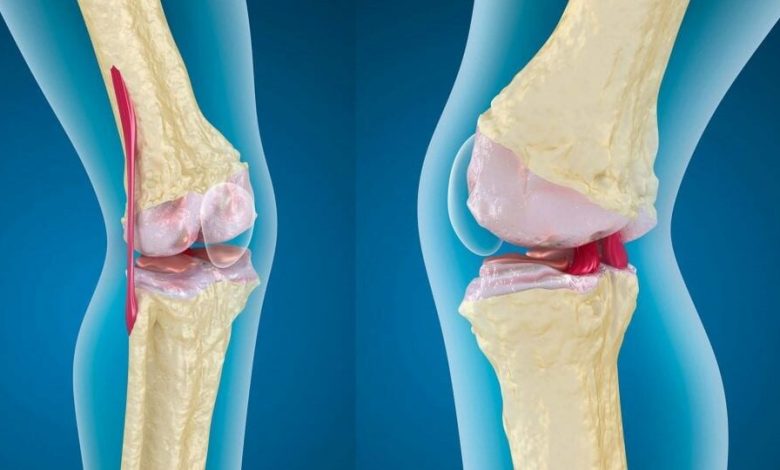 أفضل كريم لعلاج تمزق الأربطة