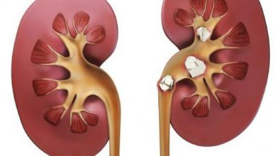 الأعراض بعد تفتيت الحصى بالمنظار