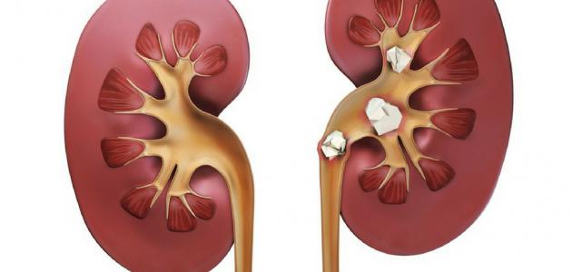 الأعراض بعد تفتيت الحصى بالمنظار