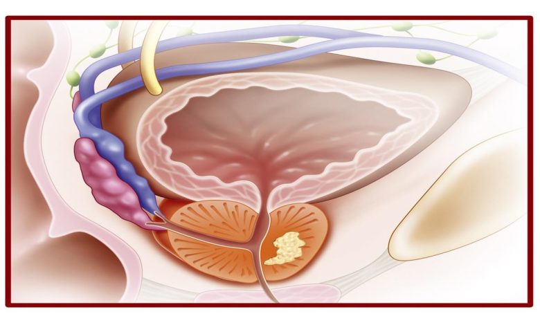 التهاب البروستاتا المزمن قلق غير مبرر
