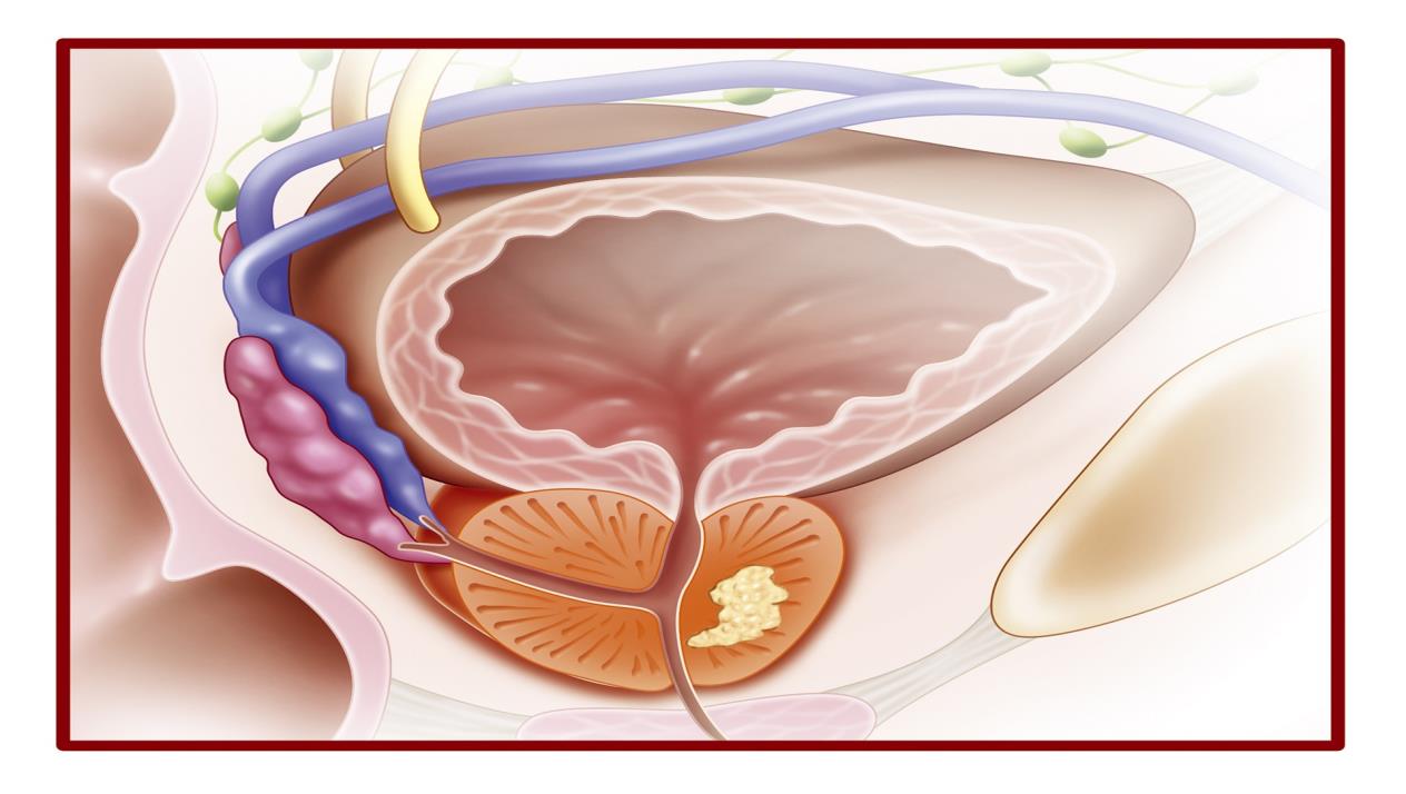 التهاب البروستاتا المزمن قلق غير مبرر