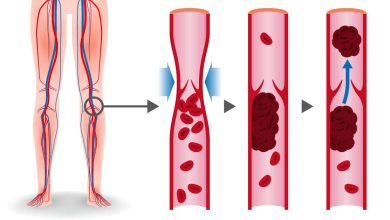 تجربتي مع جلطة الساق