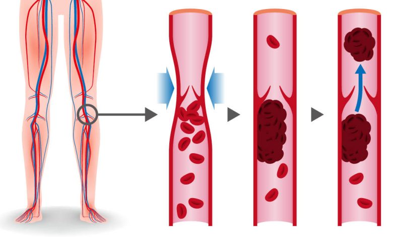 تجربتي مع جلطة الساق