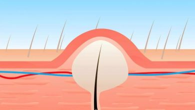 خلطة لإزالة الشعر تحت الجلد في 3 دقائق