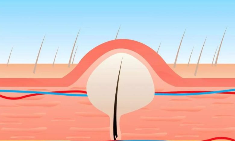 خلطة لإزالة الشعر تحت الجلد في 3 دقائق