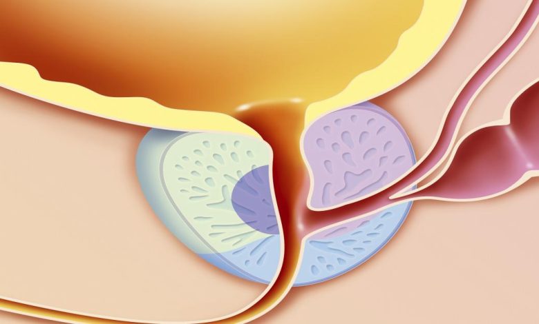 شفيت من التهاب البروستاتا المزمن