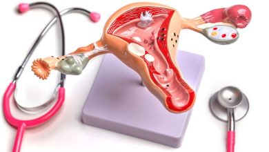 علاج حرقة في فتحة المهبل للعذراء