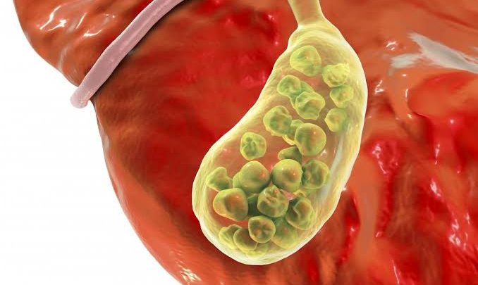 علاج حصى المرارة جابر القحطاني