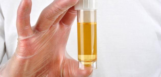 علاج نزول البروتين في البول