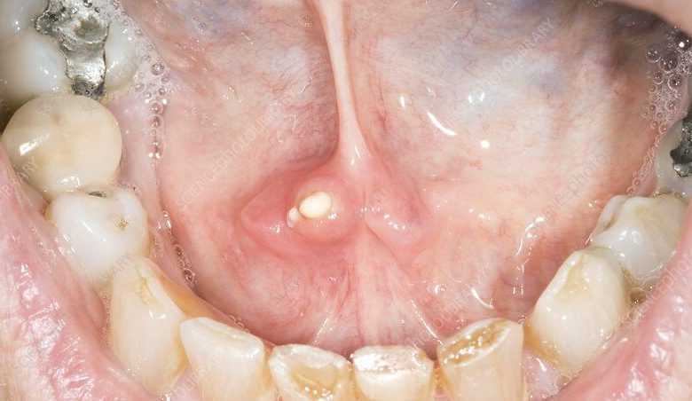 ماهي طريقة التدليك لاخراج الحصى من الغدد اللعابية