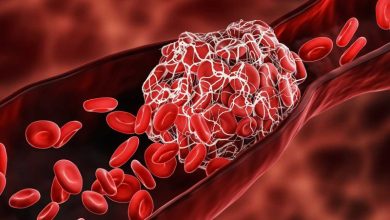 هل تخثر الدم يقتل الجنين