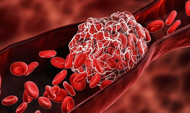 هل تخثر الدم يقتل الجنين