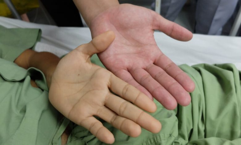 هل فقر الدم يسبب ازرقاق اليدين