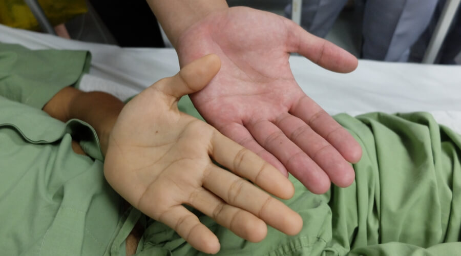 هل فقر الدم يسبب ازرقاق اليدين