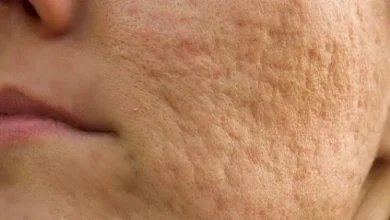 كريم ازالة اثار الحبوب