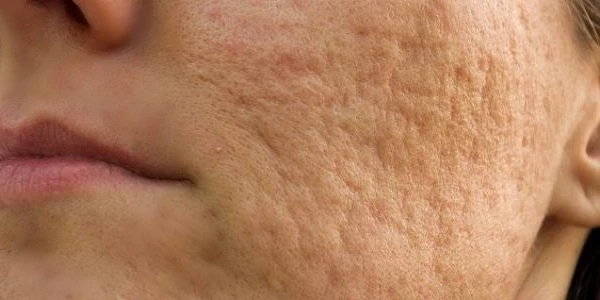 كريم ازالة اثار الحبوب