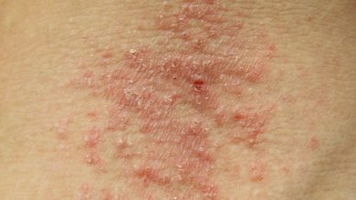 مرض الإكزيما الأعراض والعلاج