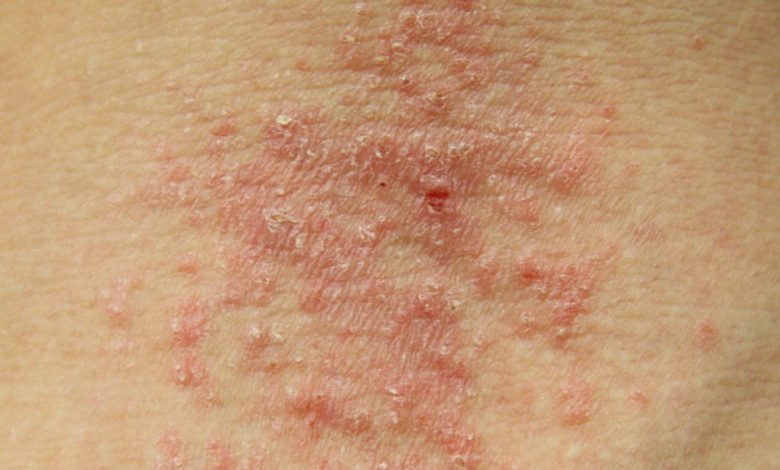 مرض الإكزيما الأعراض والعلاج