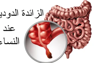 اعراض الزائدة الدودية عند النساء