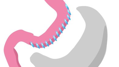 تكميم المعدة