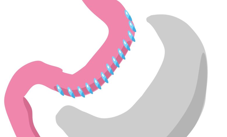 تكميم المعدة