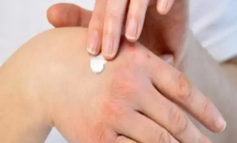 كريم مضاد حيوي