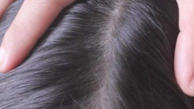 تفسير حلم القمل في الشعر