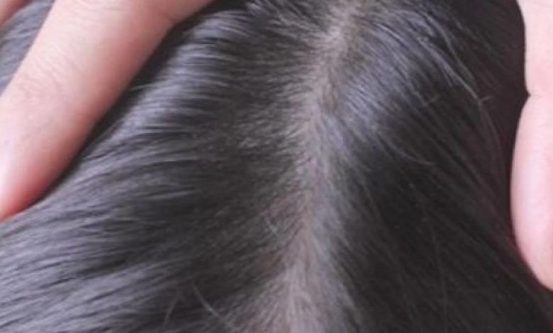 تفسير حلم القمل في الشعر